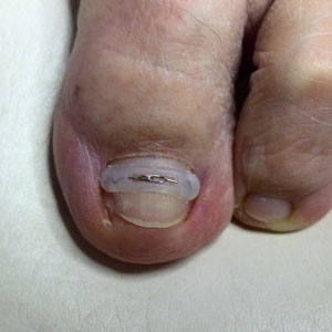 Fussnagelung Fussnagelung